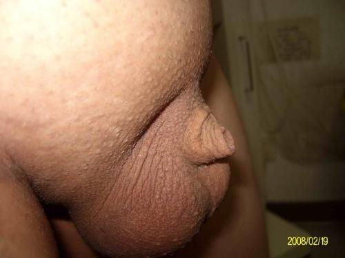 隐匿性阴茎.jpg